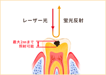 ダイアグノデントの原理